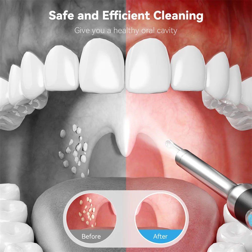 Visible Purity Tonsil Stone Remover